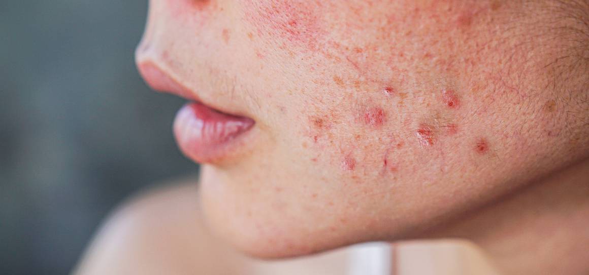 Jak se dermatologové zbavují akné