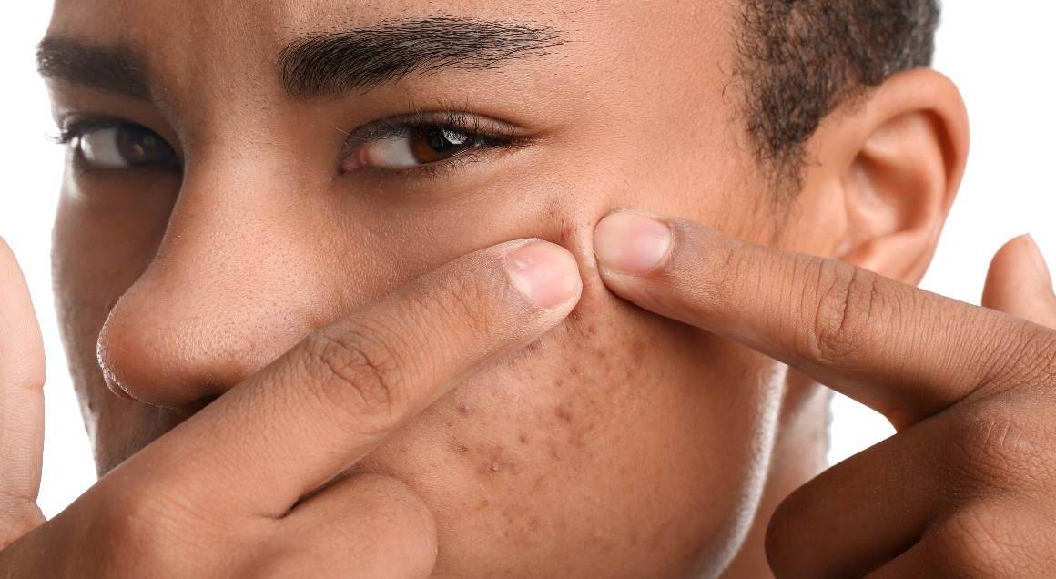 Co vyvolává cystické akné?