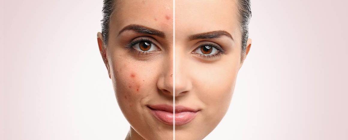 Zhoršuje mytí obličeje akné?
