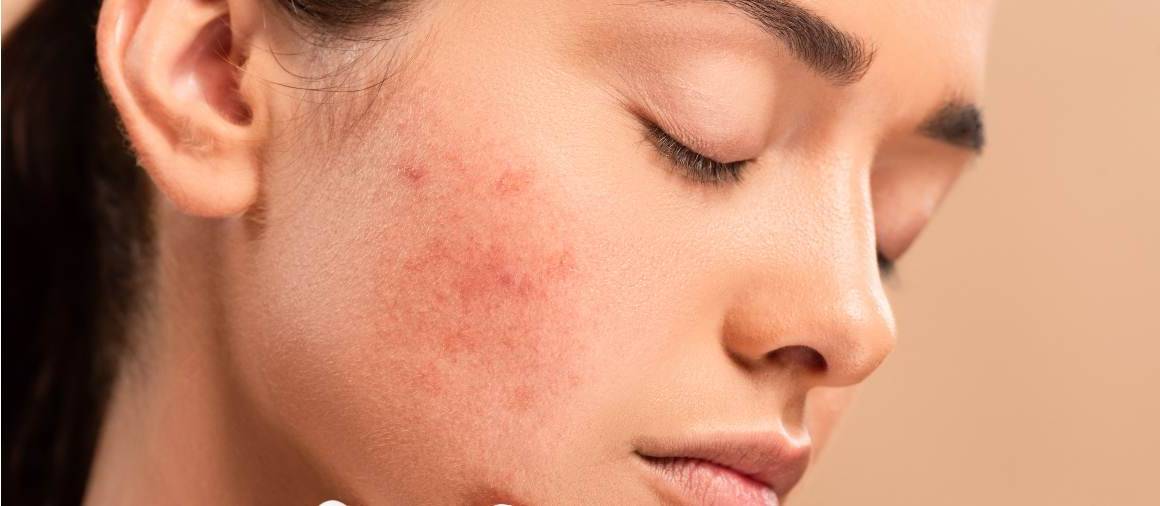 Co dermatologové obvykle předepisují na akné?
